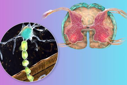Two Investigational Treatments for ALS Show Glimmer of Hope
