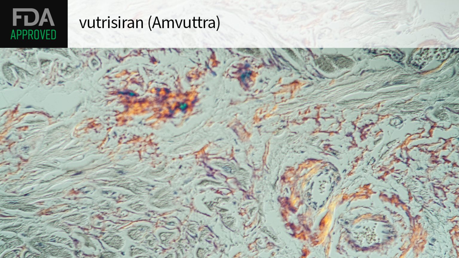 Vutrisiran Snags FDA Approval for TTR Amyloidosis Cardiomyopathy