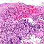 Immune cell dysfunction in GI tract may lead to onset of inflammatory bowel disease