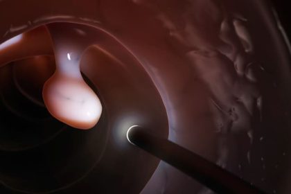 Cold EMR Safer for Colorectal Polyp Removal