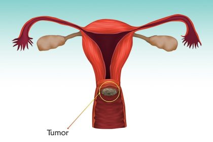 OK to Skip Pelvic Lymph Node Dissection in Cervical Cancer?
