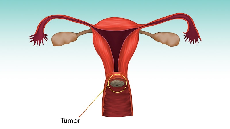 OK to Skip Pelvic Lymph Node Dissection in Cervical Cancer?