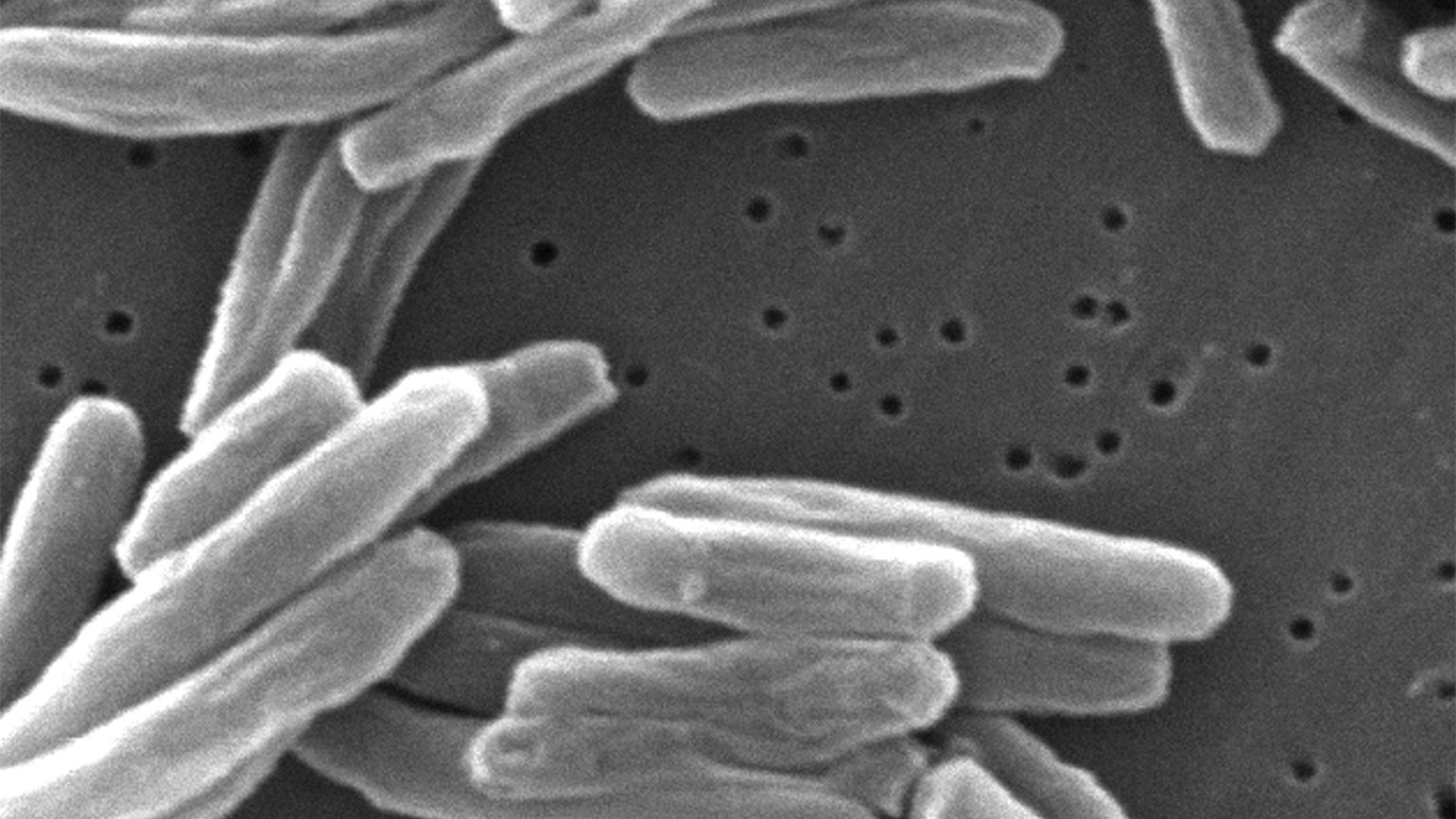 U.S. Tuberculosis Cases Rose to Their Highest Levels in More Than a Dozen Years