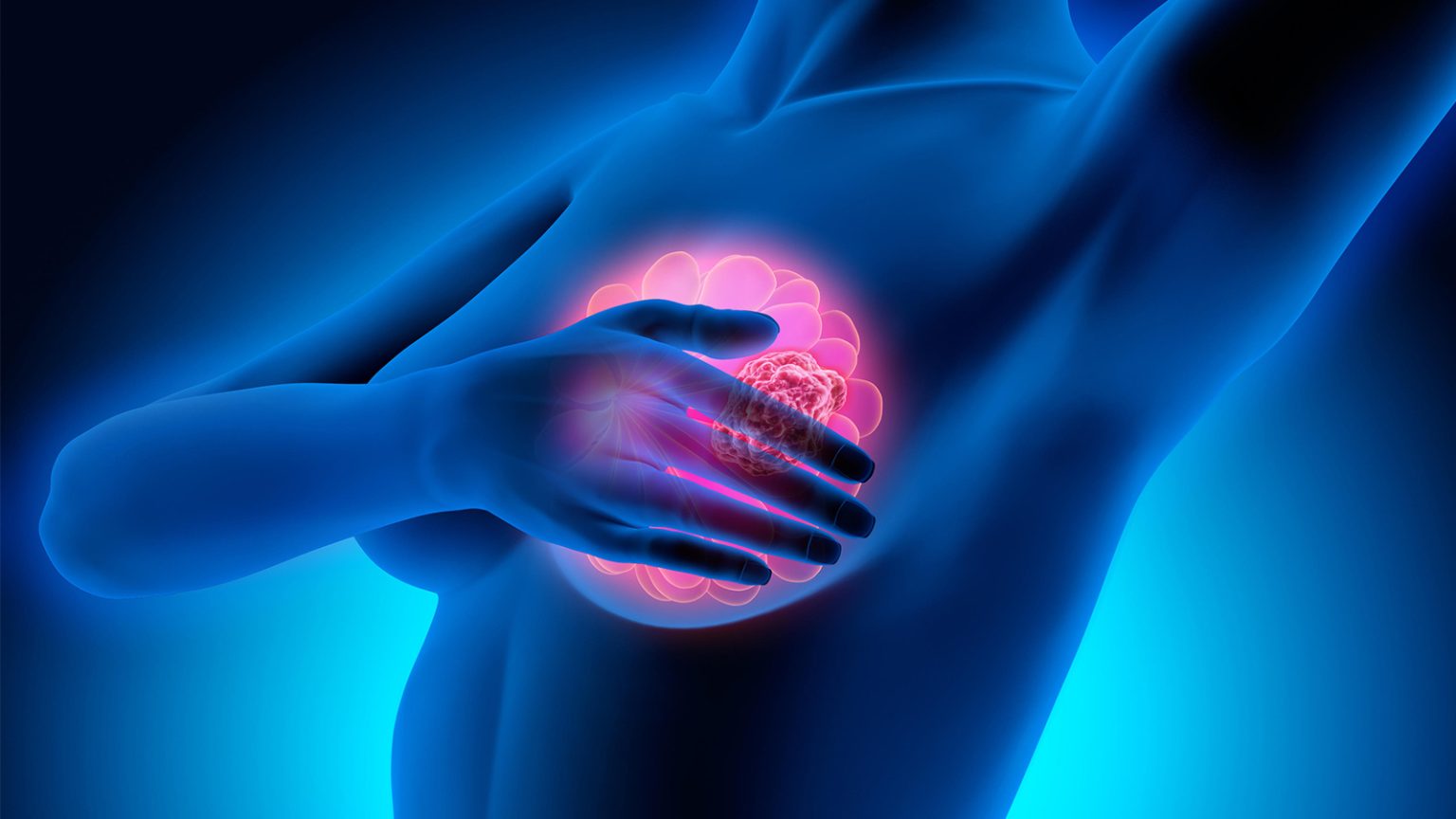 No OS Boost With Palbociclib and Endocrine Therapy in Premenopausal Breast Cancer