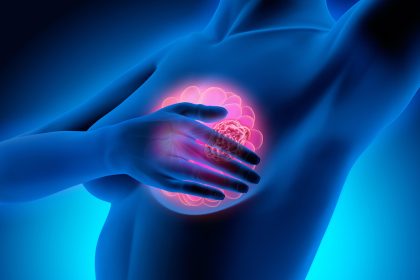 No OS Boost With Palbociclib and Endocrine Therapy in Premenopausal Breast Cancer
