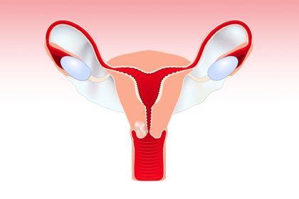 Does Adding Chemo to RT Improve Survival in Cervical Cancer?