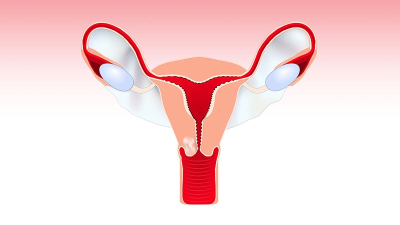 Does Adding Chemo to RT Improve Survival in Cervical Cancer?