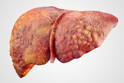 Nutrition Therapy Useful for Alcohol-Related ACLF