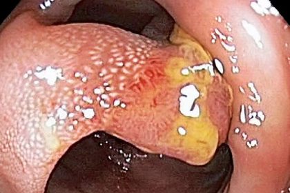 Advanced Adenomas Signal Higher Risk for CRC, Mortality