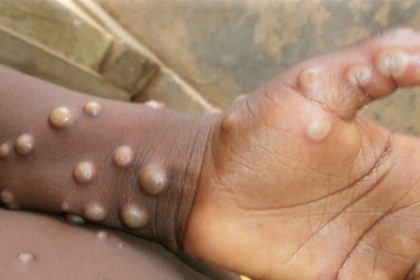 Africa requires over $220 million to sustain Mpox response – Africa CDC, WHO 