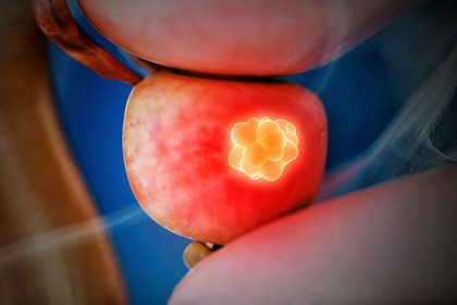 Study Gives Clinical Edge to Transperineal Prostate Biopsies
