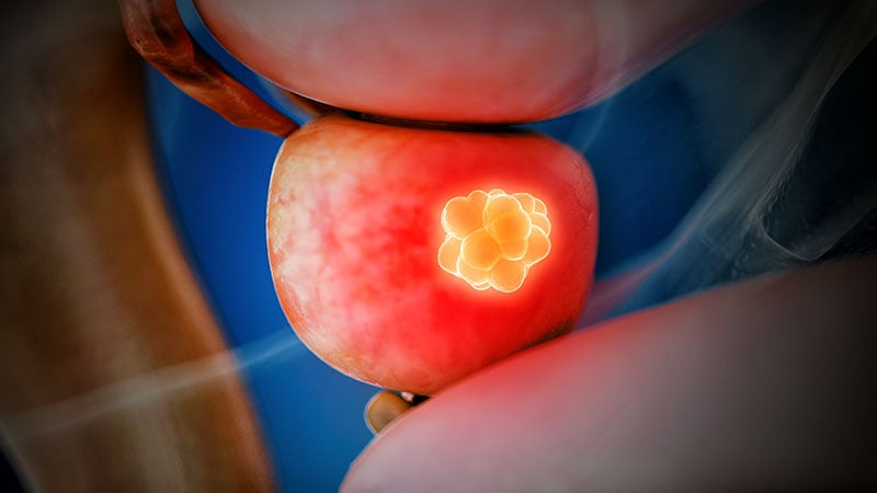 Study Gives Clinical Edge to Transperineal Prostate Biopsies
