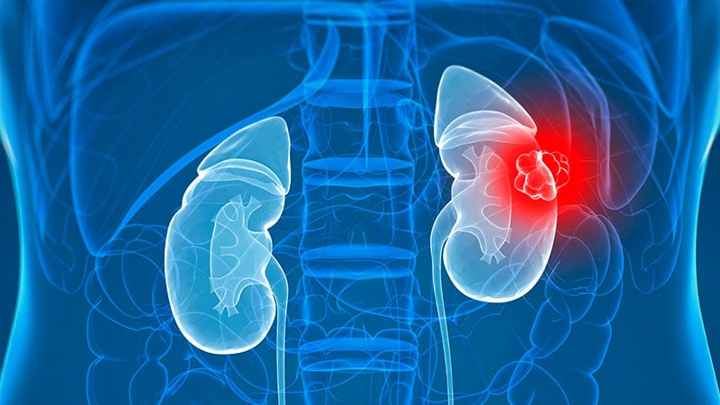 How Lifetime Weight Patterns Influence Kidney Cancer Risk