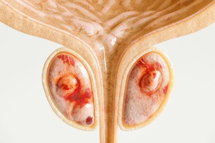 BRCA1 Contribution to Prostate Cancer Called Into Question