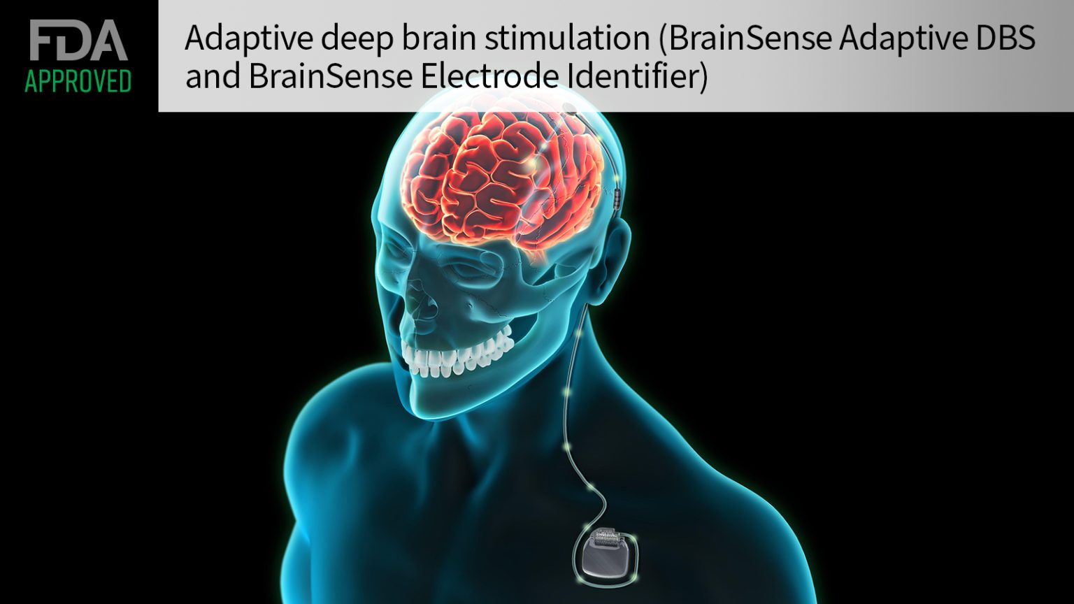 FDA Approves Adaptive Deep Brain Stimulator for Parkinson’s Disease