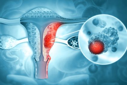 New ASCO Guidelines for Advanced Ovarian Cancer