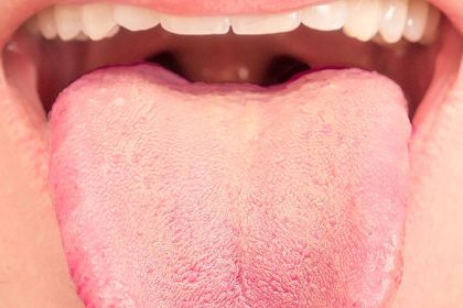 Can RT Dose to Tongue Mucosa Predict Taste Loss in HNC?