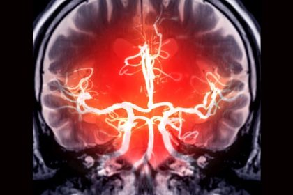 Cerebral Small Vessel Disease Prevalence Rises in T1D
