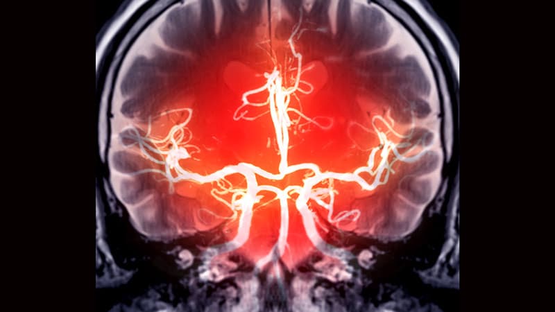 Cerebral Small Vessel Disease Prevalence Rises in T1D
