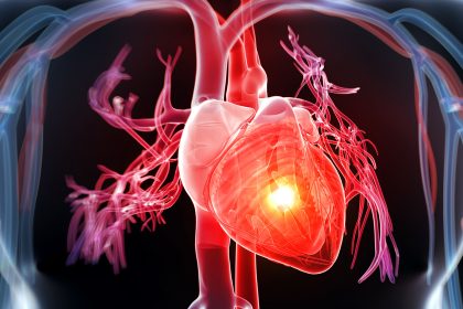 Safer Antiplatelet Routines, Non-Statin Meds Feature in New Heart Attack Guidelines