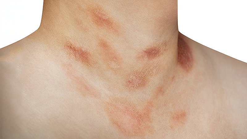 Pityriasis Rosea Before 15 Weeks May Up Pregnancy Risks
