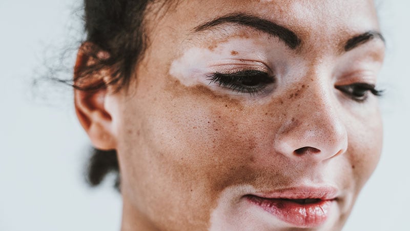 Ruxolitinib Shows Consistent Results Across Vitiligo Groups