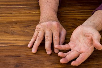 Lags in Psoriatic Arthritis vs Rheumatoid Arthritis Care
