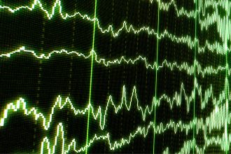 Hidden Consciousness in Comatose Patients Identified by Sleep Spindles