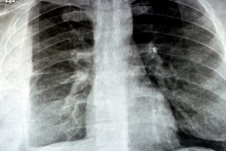 GLP-1 Agents Not Linked to Post-Op Aspiration Pneumonia, More Data Suggest