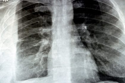 GLP-1 Agents Not Linked to Post-Op Aspiration Pneumonia, More Data Suggest