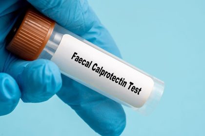 Fecal Calprotectin Predicts Disease Extent, Healing in UC