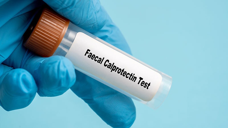Fecal Calprotectin Predicts Disease Extent, Healing in UC