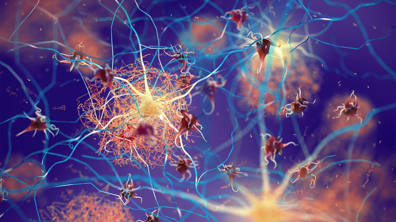 Alzheimer’s Relationship With Menopause Explored