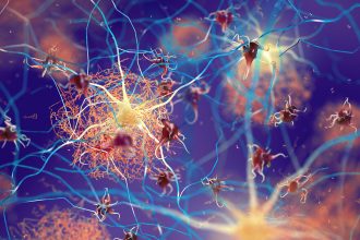 Alzheimer’s Relationship With Menopause Explored