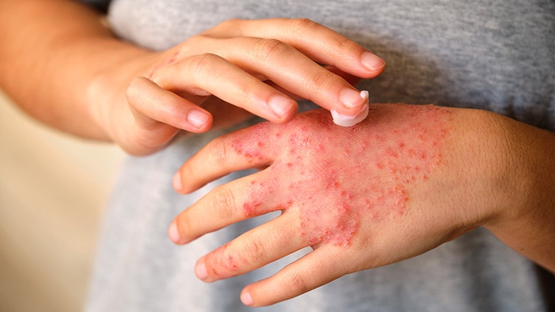 Novel JAK Inhibitor Improves QOL in Chronic Hand Eczema