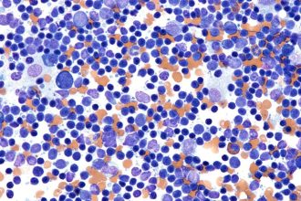 Study Charts Success in Elderly Lymphoma Tx