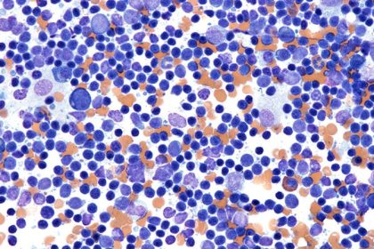 Study Charts Success in Elderly Lymphoma Tx