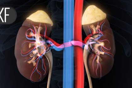 One Diuretic May Be Better for Hypertensive Patients With Kidney Stone History