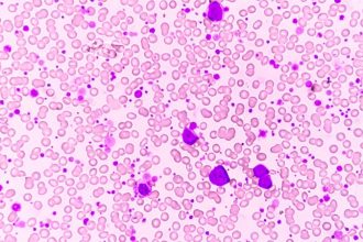 Ph-Positive Leukemia: No Longer a Death Sentence?