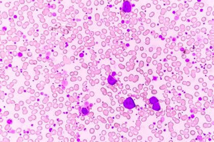 Ph-Positive Leukemia: No Longer a Death Sentence?