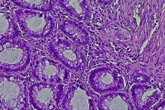 Retifanlimab Wins Upfront Indication for Anal Cancer