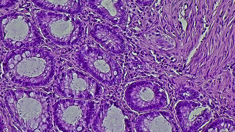Retifanlimab Wins Upfront Indication for Anal Cancer