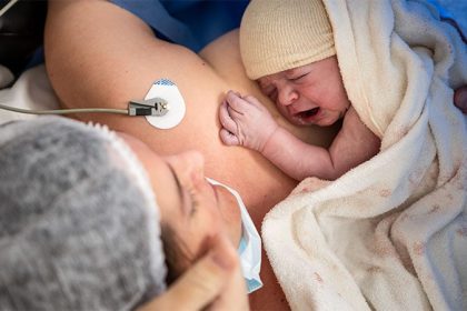 Multicountry Outcomes in Grade 3 Placenta Accreta