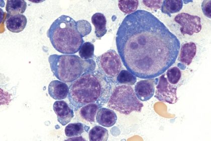 When CLL Shape-Shifts, Lymphoma Is the Dreaded Result