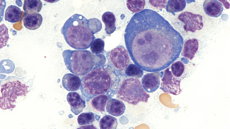 When CLL Shape-Shifts, Lymphoma Is the Dreaded Result