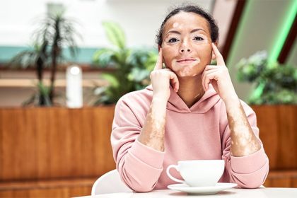 Vitiligo Study Identifies Three Patient Burden Profiles