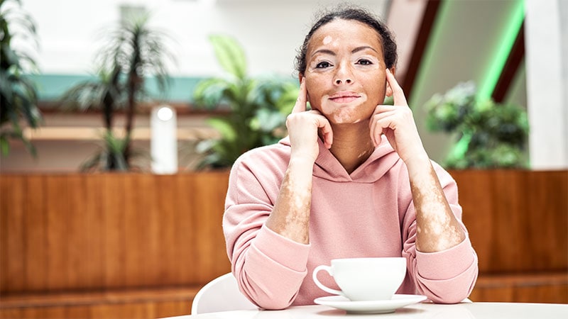 Vitiligo Study Identifies Three Patient Burden Profiles