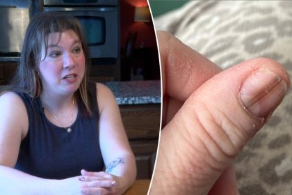 Mom credits TikTok video for life-saving cancer diagnosis after strange nail marking