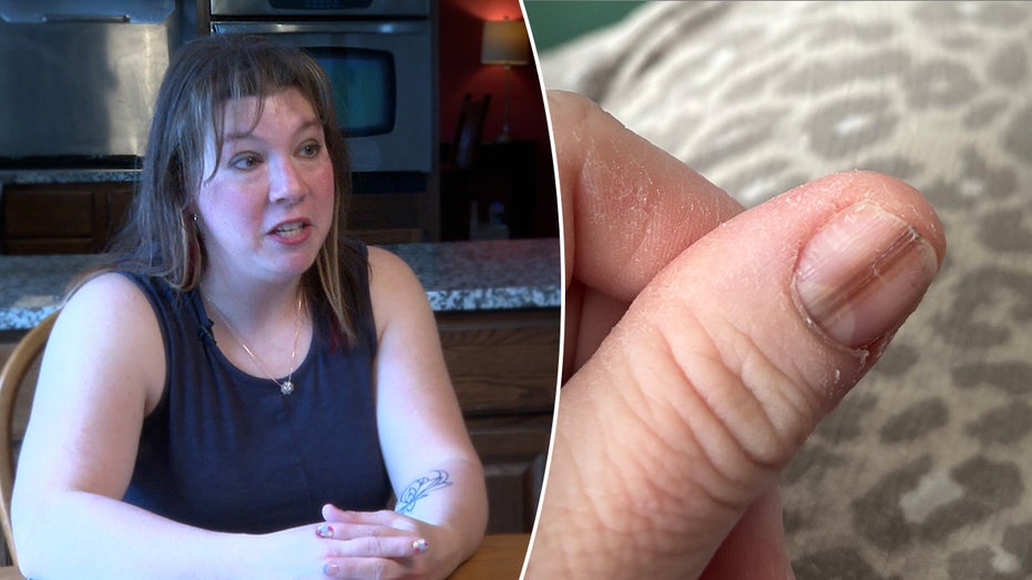 Mom credits TikTok video for life-saving cancer diagnosis after strange nail marking