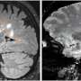 MRI could replace painful spinal tap to diagnose multiple sclerosis more quickly